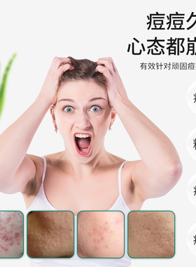 冰王芦荟清痘膏淡化痘印去痘膏