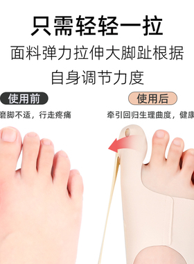大拇指头外翻矫正器可调节