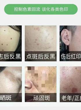控色霜皮秒激光术后点完痣点斑后防反黑修复霜淡化黑色素溶色膏