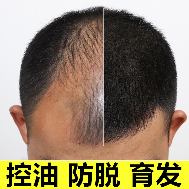 柏詩春天生薑王洗髮水男女士正品老薑王防脫髮生髮增發密發育發液