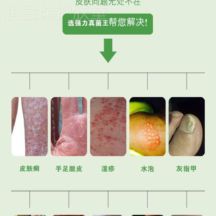 正品【强力真菌王】专治各种顽固性皮肤病癣脚气烂脚丫过敏真菌膏 - 图3