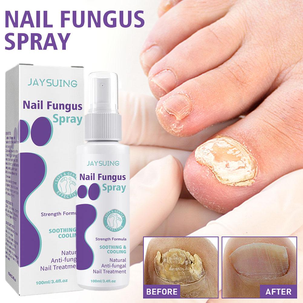 推荐100ml Effective Anti-Fungal Feet Infections Athlete Foot - 图3