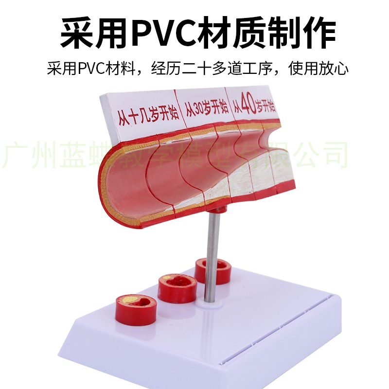 新品人体支脉硬化粥样 心血管硬化动脉模型 血全模型人体血管模型 - 图1