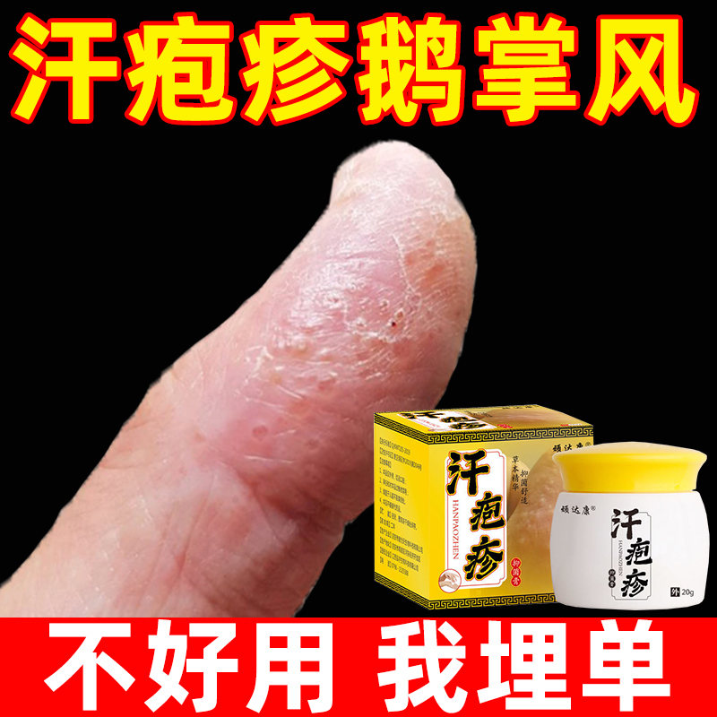 直销手痒起小水泡手气止痒脱皮杀菌汗状疱疹手上小水泡专用软膏汗-图2