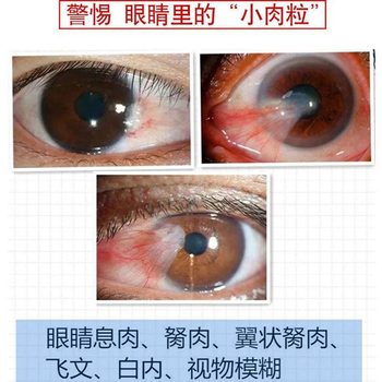 ເອົາ pterygium ຕາອອກແລະຢອດຕາ J ທີ່ມີ pterygium ມີຄວາມຮູ້ສຶກຂອງຮ່າງກາຍຕ່າງປະເທດແລະຕາບອດຍ້ອນນ້ໍາຕາ.