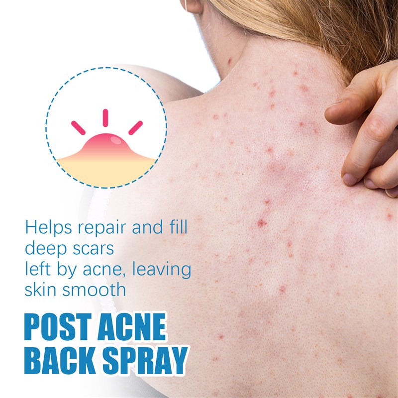 推荐Back Acne Treatment Spray Redness Calm Soothe Pores Shri-图2