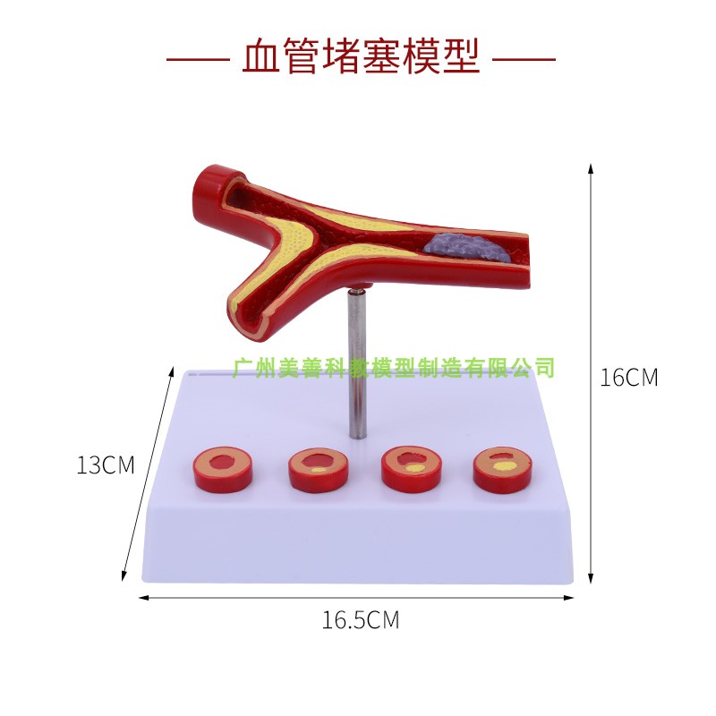 极速人体支脉粥样硬化人体血管 血管模型血管堵塞老年人血管病理 - 图2