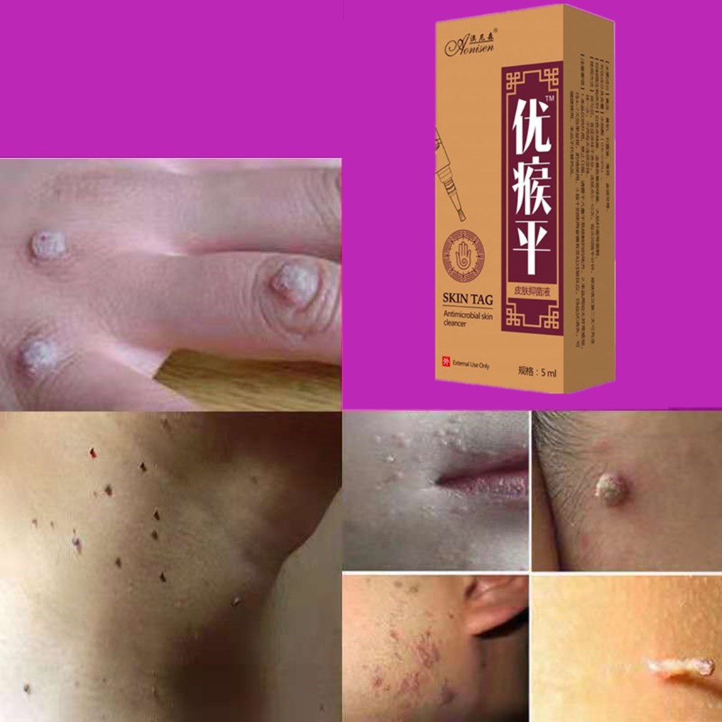 Body-Warts-Removal-Cream Skin-Tag-Remover Foot-Care 5ML 1-Bo-图1