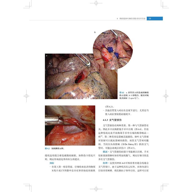 【新华文轩】胸腔镜肺叶肺段切除术图解与视频 正版书籍 新华书店旗舰店文轩官网 上海科学技术出版社 - 图2