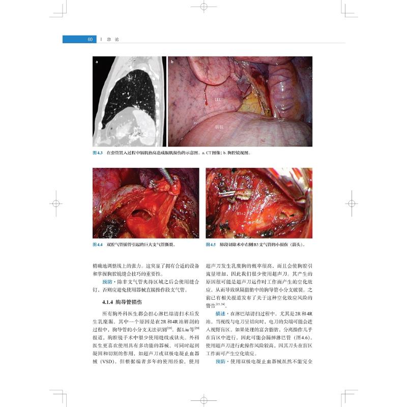 【新华文轩】胸腔镜肺叶肺段切除术图解与视频 正版书籍 新华书店旗舰店文轩官网 上海科学技术出版社 - 图0