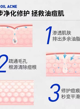 卢曼祛痘专家官方正品顺丰包邮