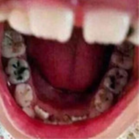 牙痛止疼药速效治特效药专用喷雾牙齿松动萎缩晃动
