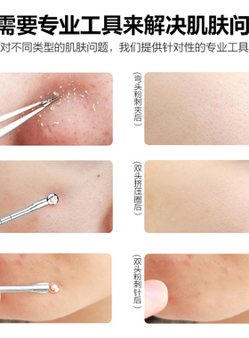 粉刺夹镊子挤黑头暗疮针