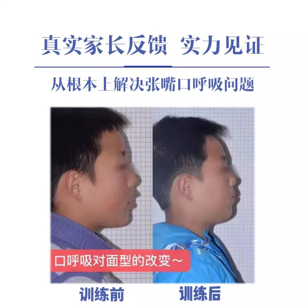 儿童唇肌矫正训练器Lips凸嘴露牙龈张口呼吸偏颌吐字不清嘴唇无力