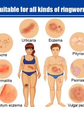 Skin itching cream for external use, causing itching