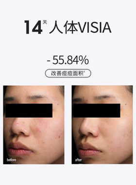 三蛋丸SOUNDER ONE 15%壬二酸净颜精华乳控油祛痘净透舒缓保湿