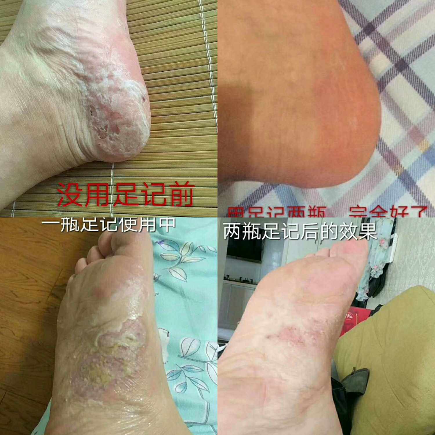 欧果足记清爽抑菌液足迹脱皮50喷剂 微微盈超市 服务大家足霜