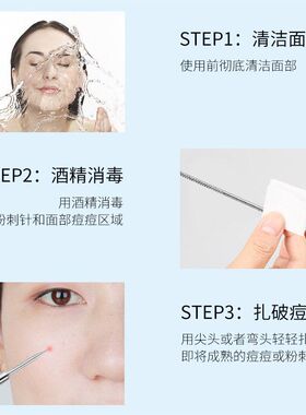 可绮不锈钢防滑暗疮针双头粉刺针面部挑痘痘针去黑头