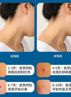 非药膏去除肉粒皮赘肉赘套装