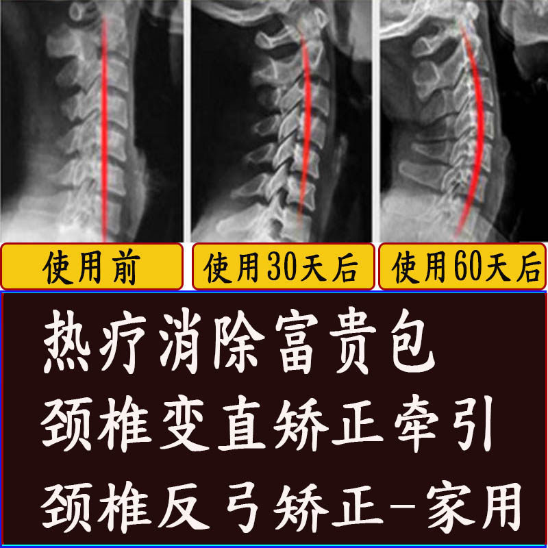 颈椎曲度变直反弓纠正器理疗枕富贵包专用磁疗