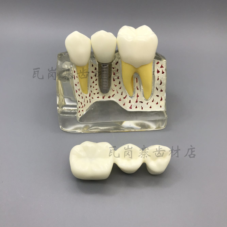 牙科口腔教学 4倍种植解说模型 种植牙解说 可拆卸 医患沟通 - 图1