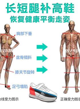 扁平足弓支撑鞋垫XO型腿