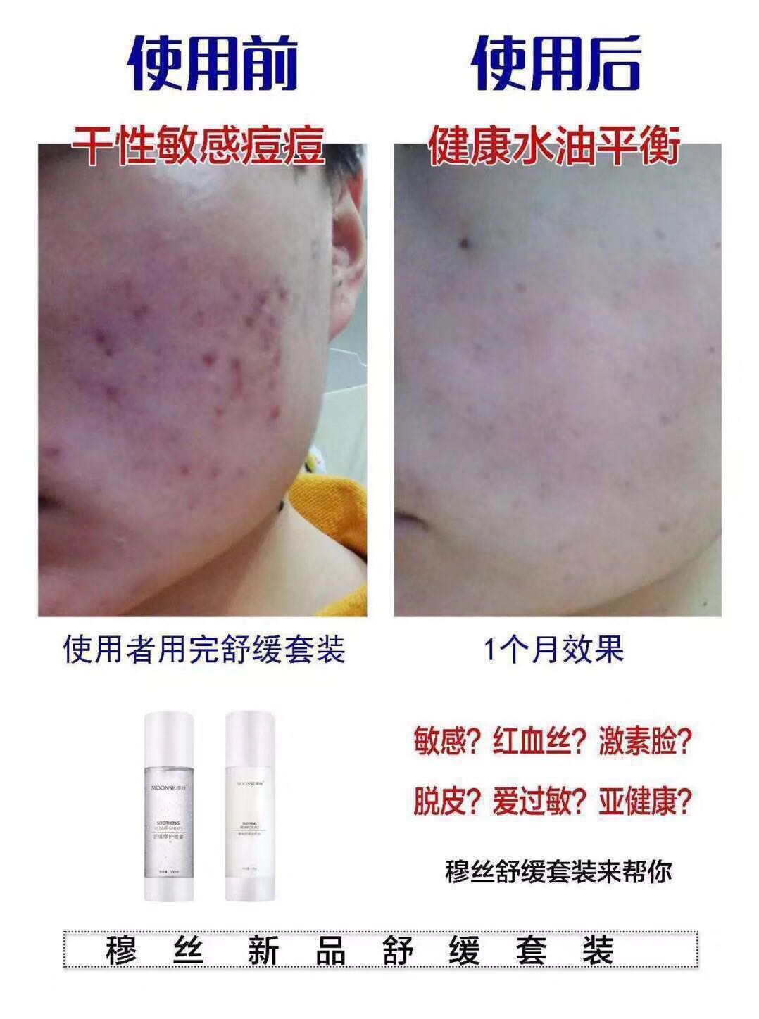 修复敏感肌肤 舒缓 改善红雪丝 MOONSE 穆丝化妆品正品舒缓修复乳 修复敏感肌肤 舒缓 改善红雪丝 MOONSE 穆丝化妆品正品舒缓修复乳