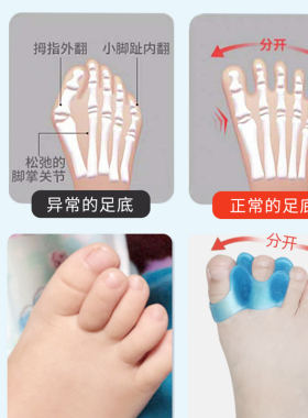 婴幼儿童脚趾重叠矫正器宝宝拇指外翻纠正弯曲内扣小孩纠正矫形器