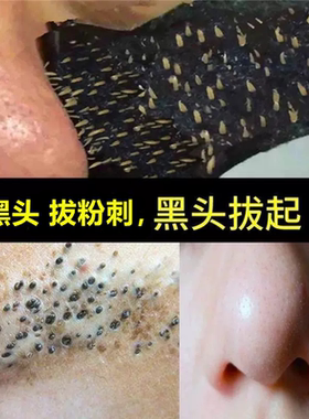 去黑头除粉刺黑头鼻贴