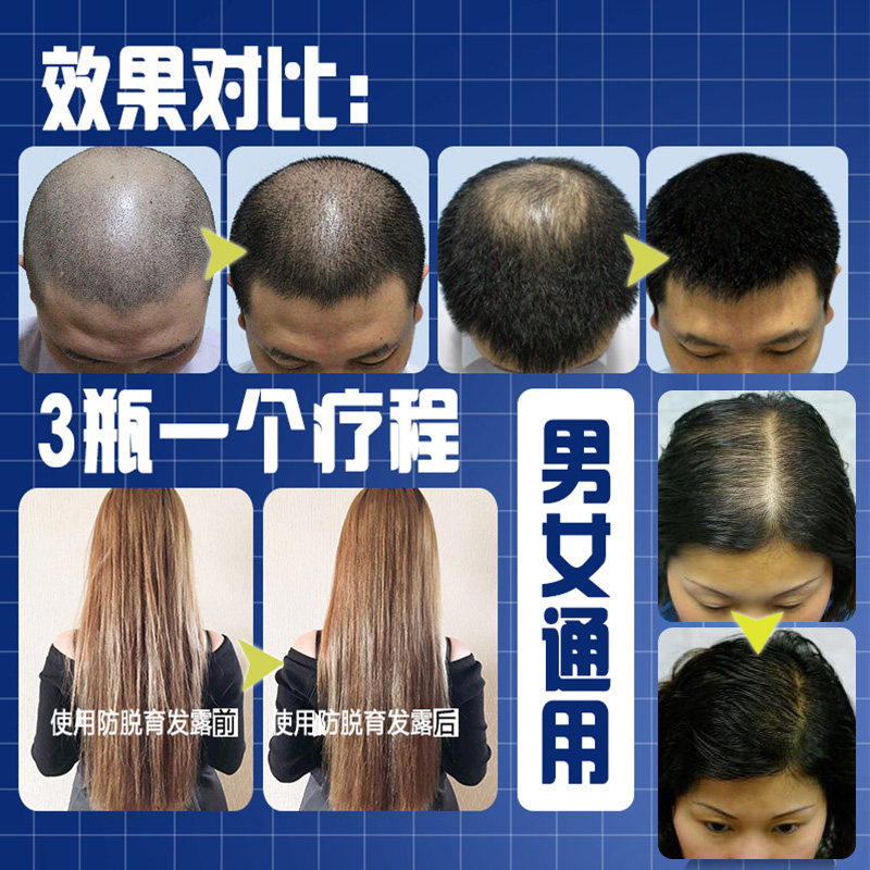 生发液头发增长液快速变长生长止脱浓密防脱生发增发密发剂脂溢性_虎窝淘