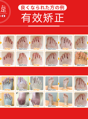乐足软钢纠大拇指外翻脚趾矫正器