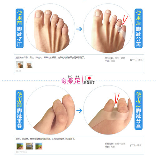 日本小拇指矫正器保护套小脚趾矫正器可以穿鞋内翻外翻分趾器男女 - 图0