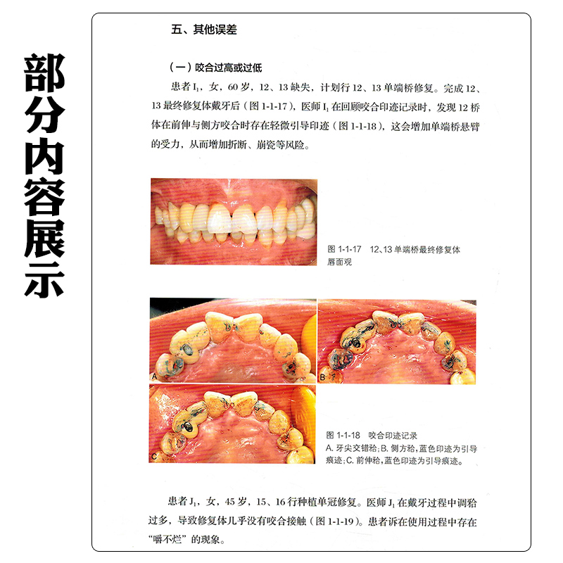 满毅口腔种植的精准戴牙技巧和并发症防治 如何避免戴牙的毫米级误差 人民卫生出版社9787117357388 - 图2