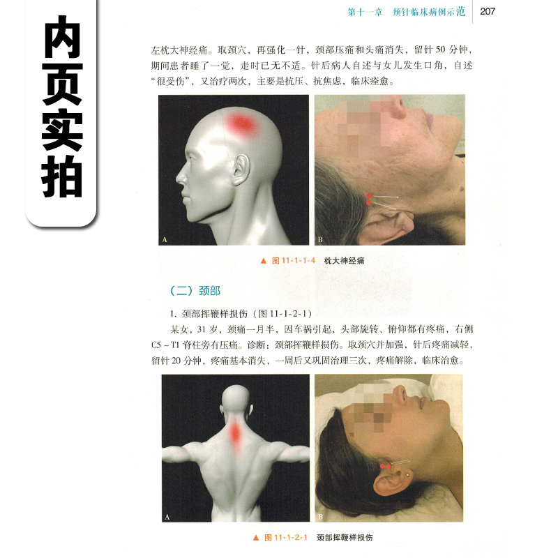 正版颊针疗法王永洲颊部医学基础颊针穴位与图谱针灸针刀临床教程中医经典名医名方参考书籍人民卫生出版社9787117244268-图2