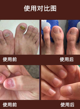 美康净脱甲套装去坏甲指甲修复液