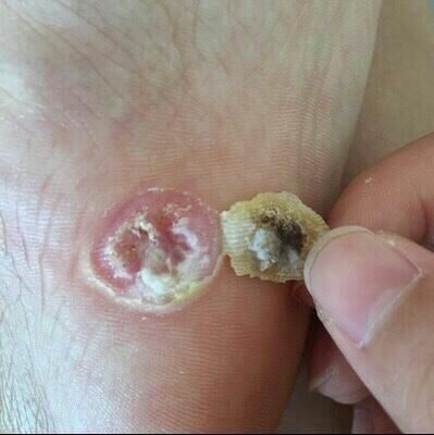 跖疣专用膏根病毒疣连根拔手足部脚底趾疣肉刺刺猴去除神器鸡眼药,淘宝优惠券,粉丝福利购,淘宝优惠卷