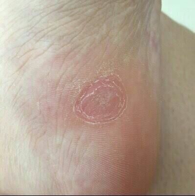 跖疣专用膏根病毒疣连根拔手足部脚底趾疣肉刺刺猴去除神器鸡眼药,淘宝优惠券,粉丝福利购,淘宝优惠卷