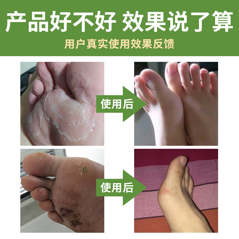金泰康旗舰店脚臭粉除臭去除脚臭止汗脚汗防臭脚气臭脚泡脚药包男女士1