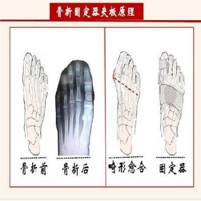 大脚指骨折 夹板护男女士男士外翻脱位指套恢复脚趾骨折固定夹板