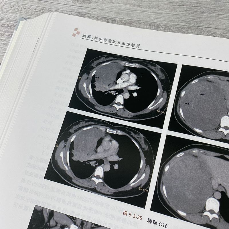 纵隔、肺疾病临床与影像解析 张嵩主编 9787030594679科学出版社 介绍了纵隔和肺疾病的临床表现和影像特点，疾病为本、影像为辅 - 图2