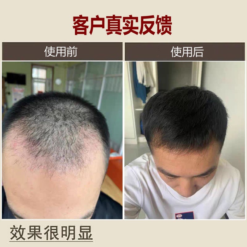 男士脱发严重专用洗发水防脱生发增发密发掉发排行榜育发密发中药 - 图0