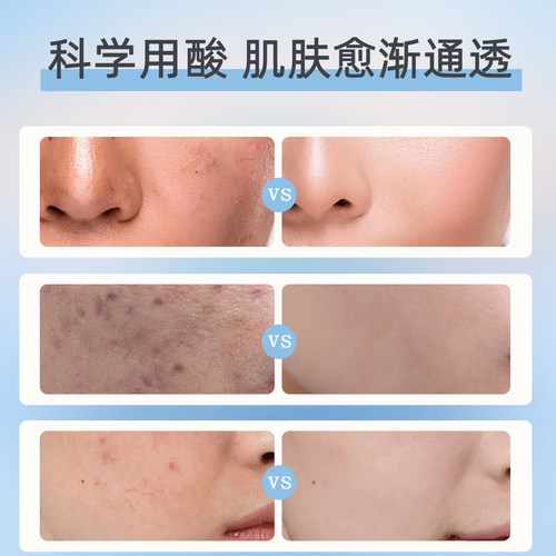 美国正品stridex水杨酸棉片去闭口酸祛痘淡化痘印清洁棉刷湿敷棉 - 图1