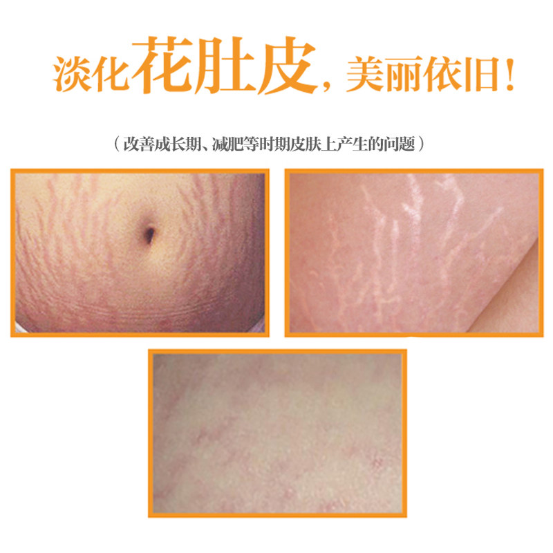  天瑞母婴妊娠纹护理