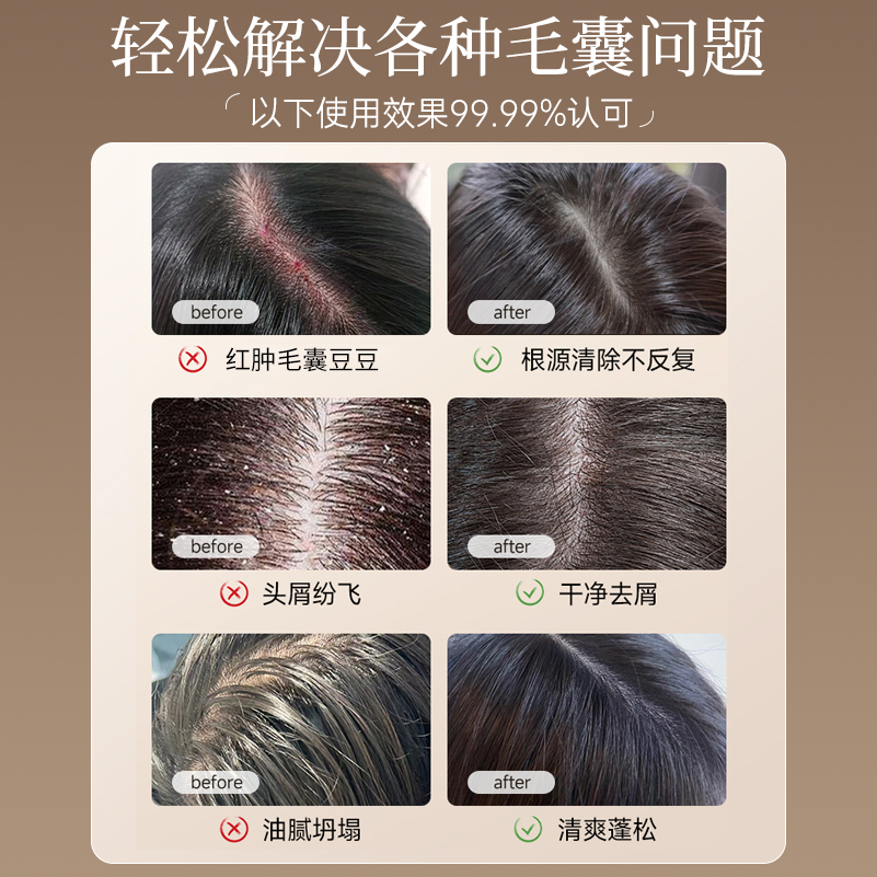 【德国品牌】毛囊洗发水除螨头皮去屑止痒炎控油蓬松洗头膏露正品