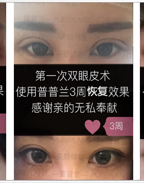 普兰术后快速恢复正品店铺号精油