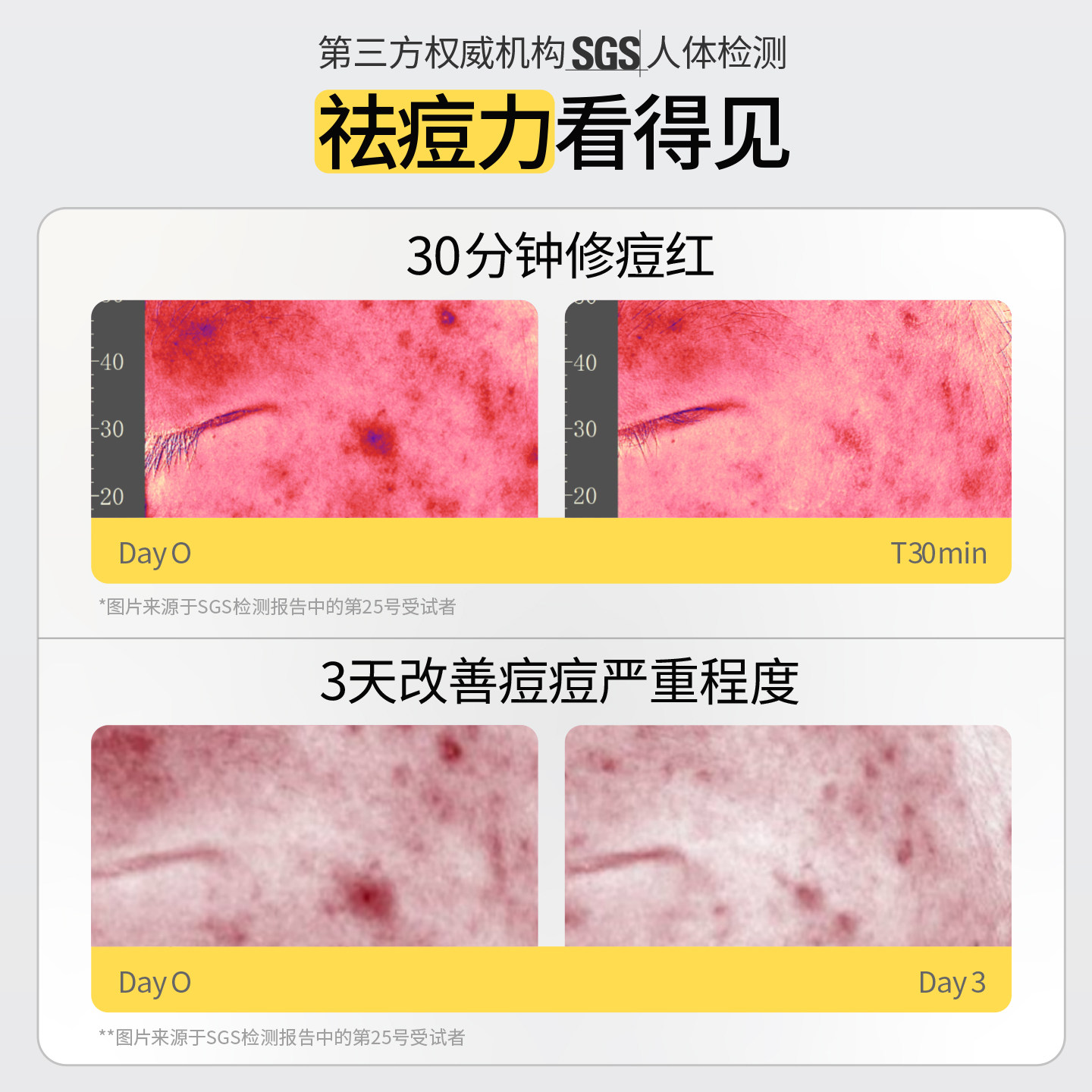 【爆款套组】羽素祛痘大灯泡精华液控油保湿去闭口水3.0抗痘湿敷