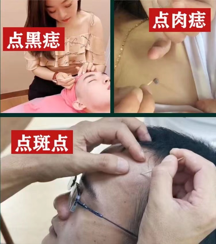 去痣点痣膏正品脸部点斑黑点痦子药水祛痣疣祛斑点雀斑专用神器仪-图1