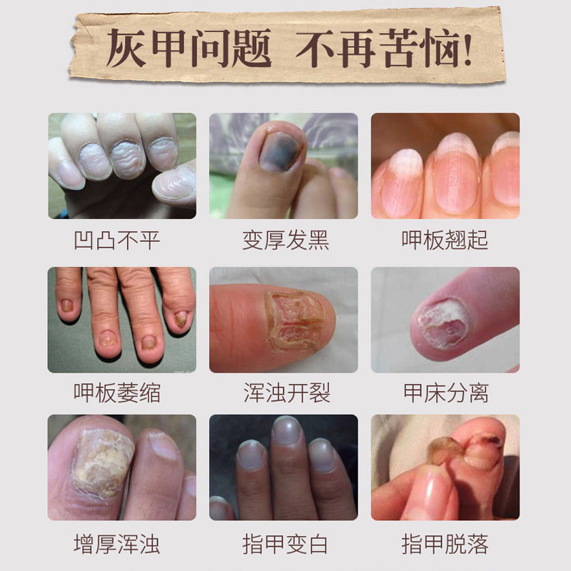 灰指甲专用液脱甲膏去除灰甲净药膏 热品库 性价比省钱购
