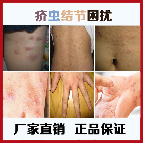 疥虱康宁专攻疥疮膏结节红疹晚上皮肤痒专用去疥螨疥虫虫卵满力净 - 图2