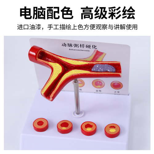 教学仿真人体病理血管堵塞动支脉粥样硬化心血管模型堵塞程度变化 - 图2